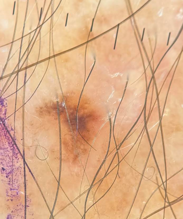 Dermoscopy image of a small asymmetric pigmented lesion later confirmed as melanoma in situ.